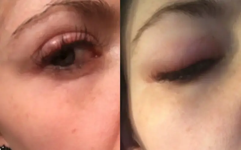 Why am I Suddenly Allergic to Eyelash Glue